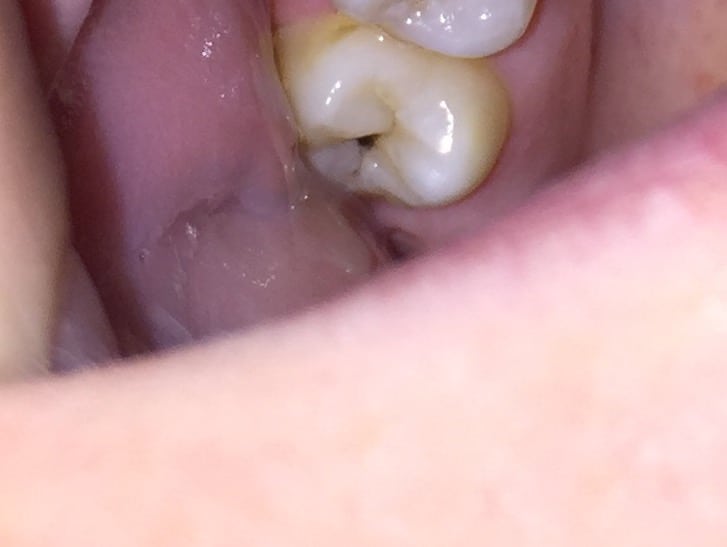 Tooth Cavity 
